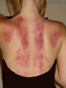 gua-sha 2